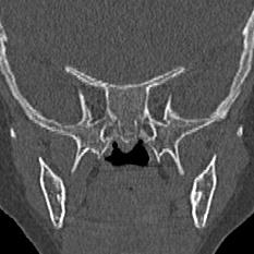 Choanal atresia (Radiopaedia 88525-105975 Coronal bone window 84).jpg