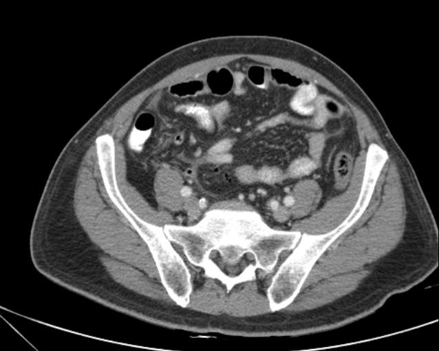 Cholecystitis - perforated gallbladder (Radiopaedia 57038-63916 A 62).jpg