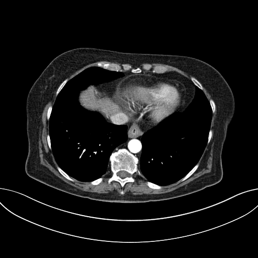 Cholecystoduodenal fistula due to calculous cholecystitis with gallstone migration (Radiopaedia 86875-103077 A 8).jpg