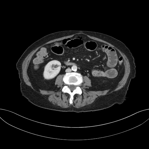 Cholecystoduodenal fistula due to calculous cholecystitis with gallstone migration (Radiopaedia 86875-103077 D 46).jpg