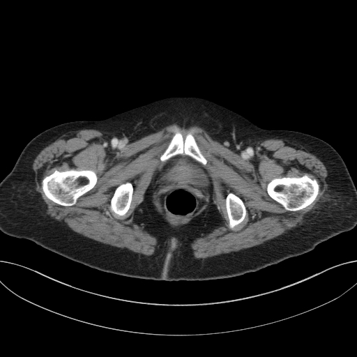 Cholecystoduodenal fistula due to calculous cholecystitis with gallstone migration (Radiopaedia 86875-103077 D 82).jpg