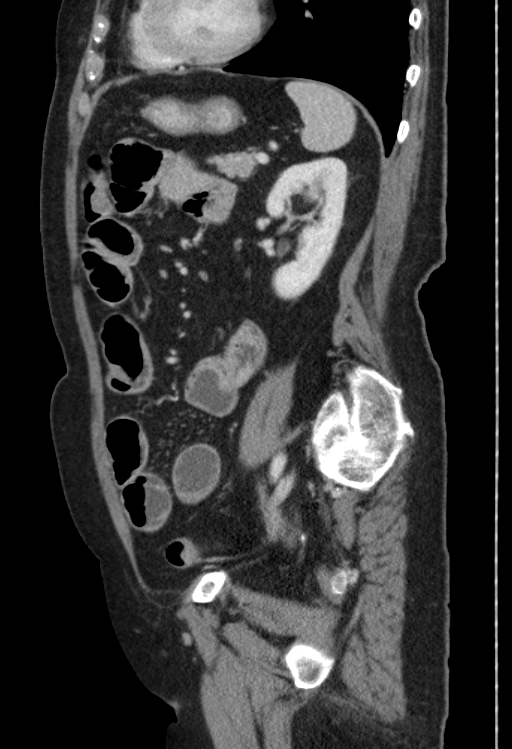 Cholecystoduodenal fistula due to calculous cholecystitis with gallstone migration (Radiopaedia 86875-103077 F 19).jpg