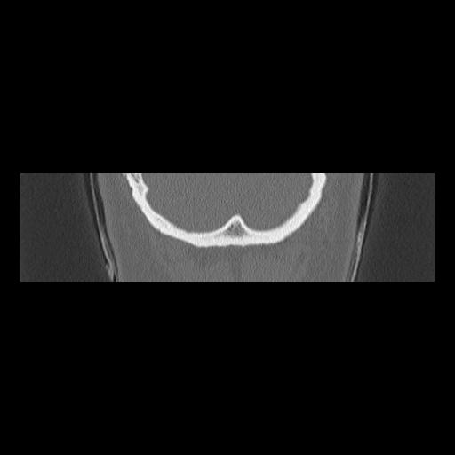 Cholesteatoma (Radiopaedia 84946-100455 Coronal bone window 156).jpg