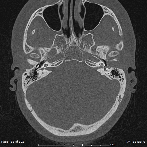 Cholesteatoma - external auditory canal (Radiopaedia 88452-105096 Axial bone window 51).jpg