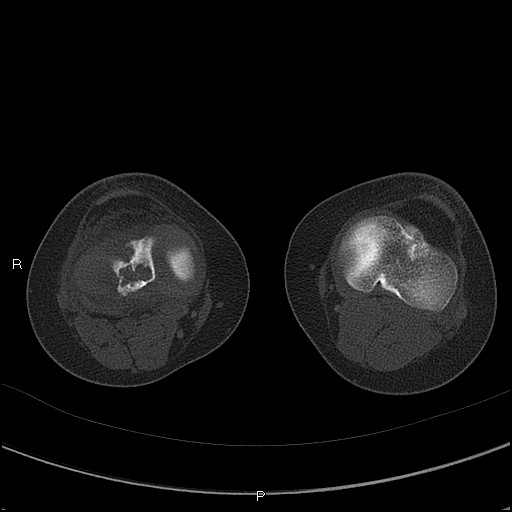 Chondroblastoma (Radiopaedia 62721-71030 Axial bone window 41).jpg