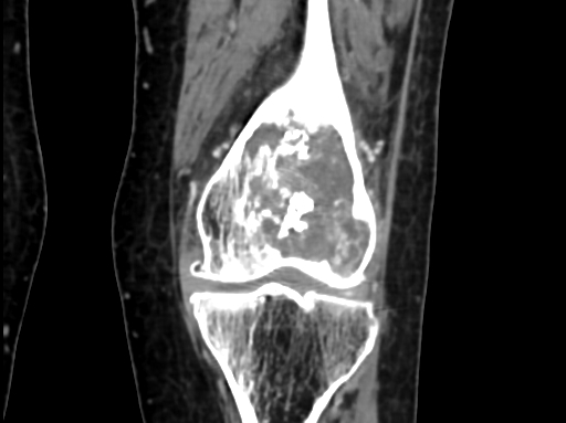 Chondrosarcoma - femur (Radiopaedia 64187-72954 C 31).jpg