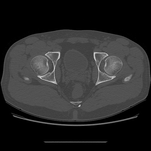 File:Chondrosarcoma of iliac wing (Radiopaedia 63861-72599 Axial bone window 101).jpg