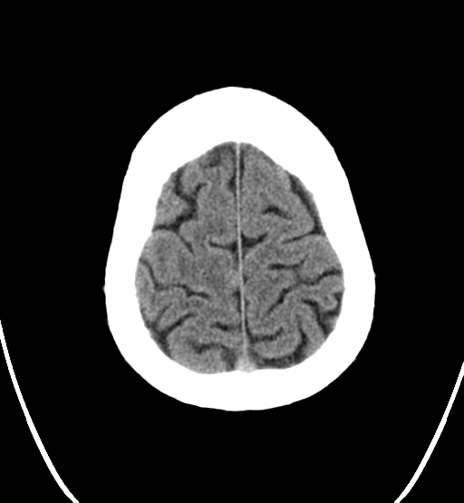 File:Chondrosarcoma of skull base- grade II (Radiopaedia 40948-43653 Axial non-contrast 26).png