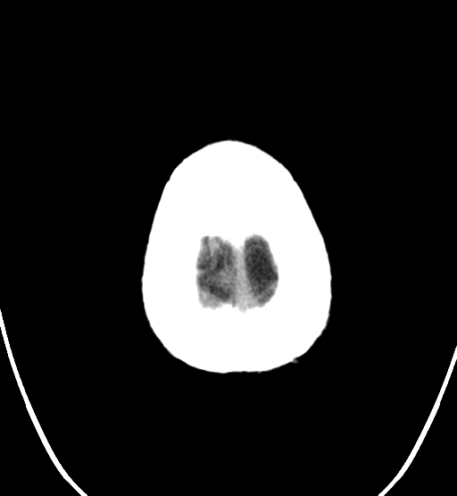 File:Chondrosarcoma of skull base- grade II (Radiopaedia 40948-43653 Axial non-contrast 29).png