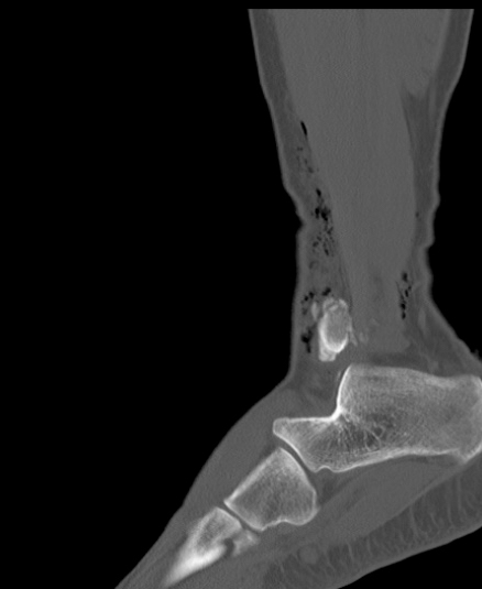 Chopart fracture (Radiopaedia 35347-36851 Sagittal bone window 49).jpg