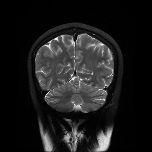 File:Chordoid glioma of third ventricle (Radiopaedia 91612-109340 Coronal T2 25).jpg