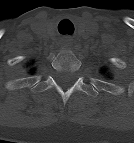 Chordoma (C4 vertebra) (Radiopaedia 47561-52188 Axial bone window 43).png