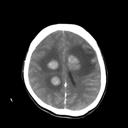 File:Choriocarcinoma of ovary with cerebral and pulmonary metastases (Radiopaedia 25983-26118 A 17).jpg