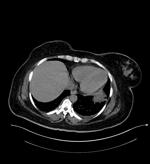 Chromophobe renal cell carcinoma (Radiopaedia 84239-99519 Axial non-contrast 25).jpg