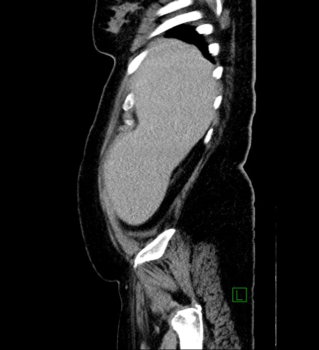 Chromophobe renal cell carcinoma (Radiopaedia 84239-99519 G 101).jpg