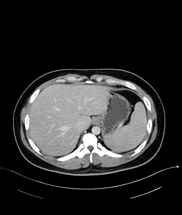 Chromophobe renal cell carcinoma (Radiopaedia 84255-99542 F 13).jpg