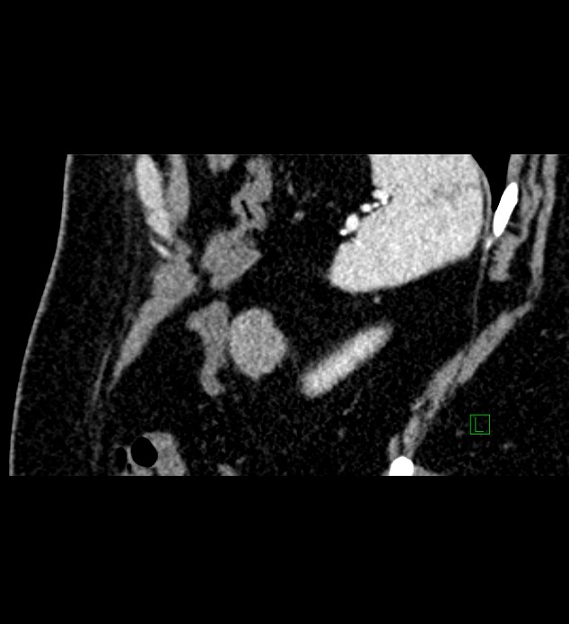 Chromophobe renal cell carcinoma (Radiopaedia 84286-99573 F 24).jpg