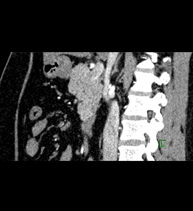 Chromophobe renal cell carcinoma (Radiopaedia 84286-99573 F 94).jpg