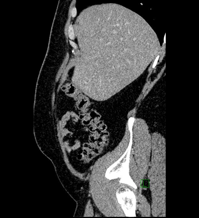 Chromophobe renal cell carcinoma (Radiopaedia 84286-99573 I 155).jpg