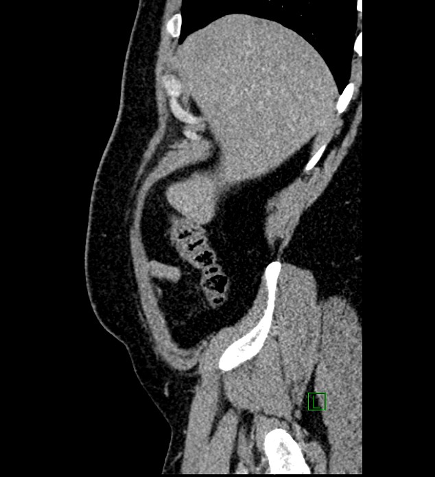Chromophobe renal cell carcinoma (Radiopaedia 84286-99573 I 166).jpg