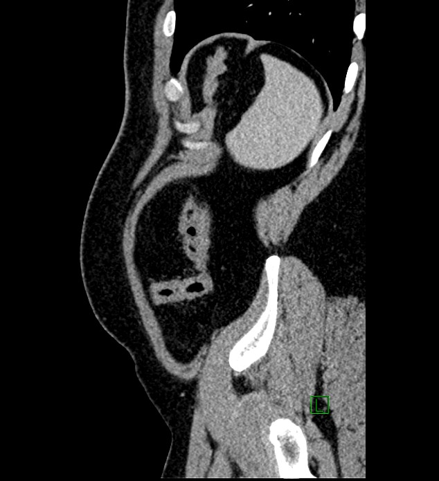 Chromophobe renal cell carcinoma (Radiopaedia 84286-99573 I 19).jpg