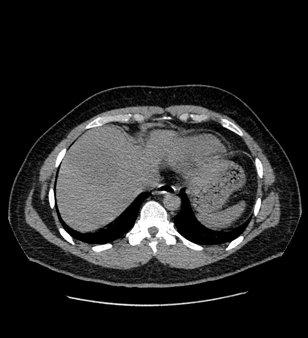 Chromophobe renal cell carcinoma (Radiopaedia 84337-99693 Axial non-contrast 6).jpg