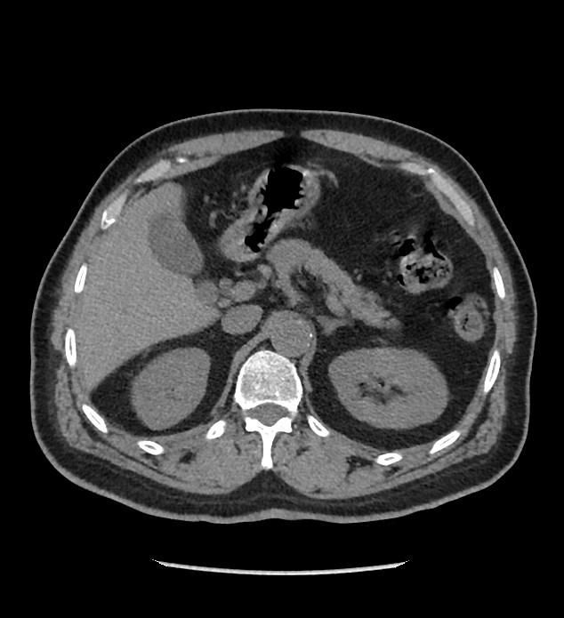 Chromophobe renal cell carcinoma (Radiopaedia 86879-103083 Axial non-contrast 22).jpg