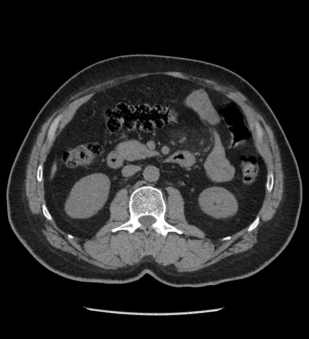 Chromophobe renal cell carcinoma (Radiopaedia 86879-103083 Axial non-contrast 43).jpg