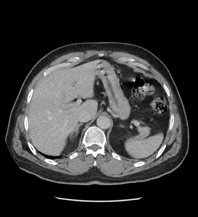 Chromophobe renal cell carcinoma (Radiopaedia 86879-103083 C 30).jpg