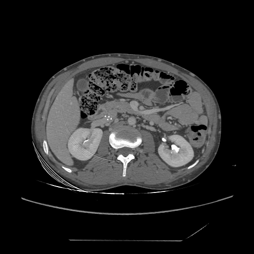 File:Chronic IVC thrombosis and resultant IVC filter malposition (Radiopaedia 81158-94800 A 84).jpg