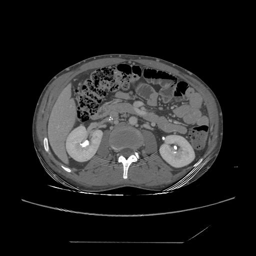 File:Chronic IVC thrombosis and resultant IVC filter malposition (Radiopaedia 81158-94800 A 88).jpg