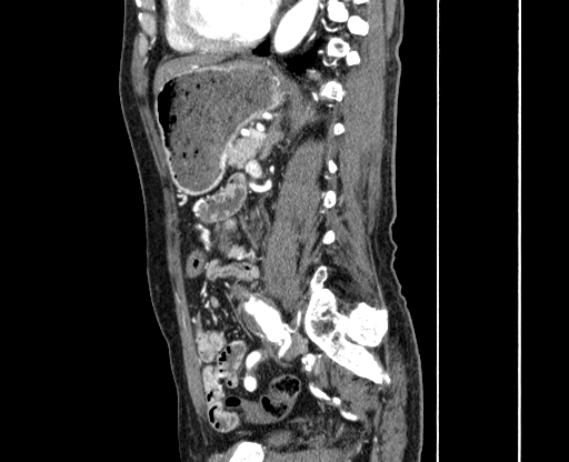 Chronic contained rupture of abdominal aortic aneurysm with extensive erosion of the vertebral bodies (Radiopaedia 55450-61901 B 48).jpg
