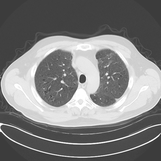 Chronic hypersensitivity pneumonitis (Radiopaedia 48107-52922 Axial lung window 21).png