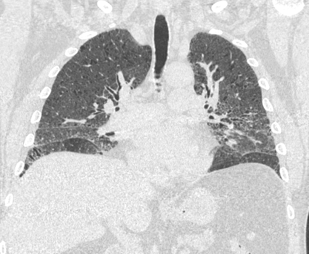 File:Chronic hypersensitivity pneumonitis (Radiopaedia 48107-52922 Coronal lung window 14).png