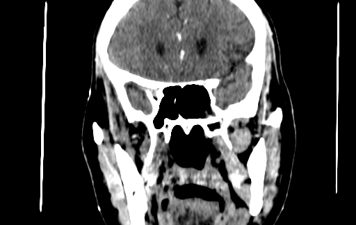 Chronic invasive fungal sinusitis (Radiopaedia 91563-109286 D 80).jpg
