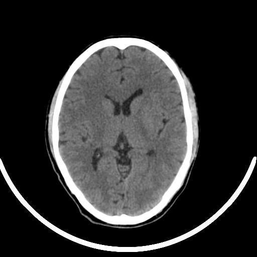 File:Chronic invasive fungal sinusitis with intraorbital and intracranial extension (Radiopaedia 56387-63046 Axial non-contrast 210).jpg