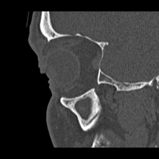 Chronic maxillary sinusitis (Radiopaedia 27879-28116 Sagittal bone window 6).jpg