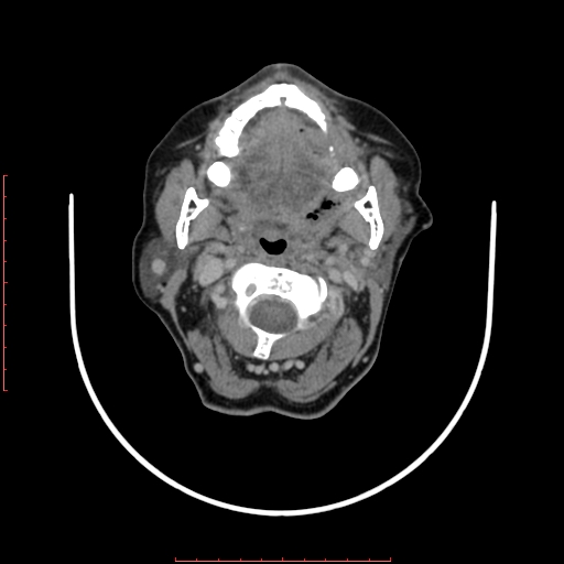 File:Chronic osteomyelitis - maxilla (Radiopaedia 23783-23927 B 51).jpg
