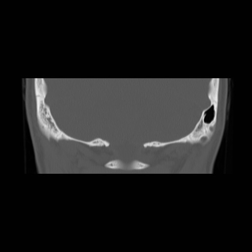 File:Chronic otomastoiditis (Radiopaedia 27138-27309 Coronal bone window 26).jpg