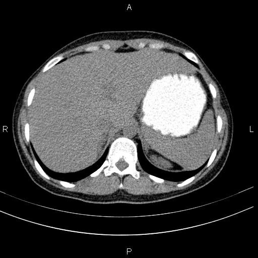 File:Chronic pancreatitis (Radiopaedia 64576-73450 Axial non-contrast 21).jpg