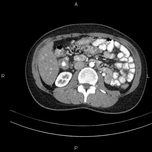 Chronic pancreatitis (Radiopaedia 64576-73450 B 77).jpg