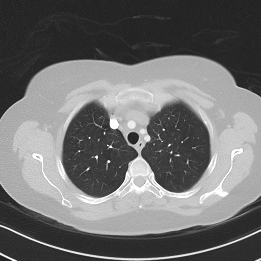 Chronic pulmonary embolus (Radiopaedia 39129-41341 Axial lung window 16).png