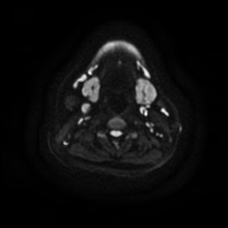 Chronic submandibular sialadenitis (Radiopaedia 61852-69885 Axial DWI 16).jpg