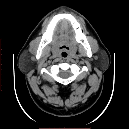 Chronic submandibular sialolithiasis (Radiopaedia 69817-79814 Axial non-contrast 73).jpg