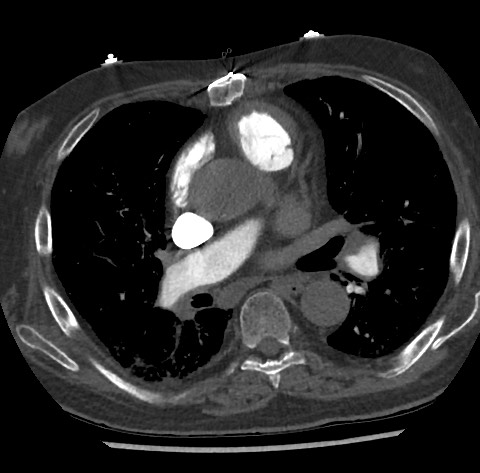 Chronic thromboembolic pulmonary disease (Radiopaedia 90694-108119 Axial C+ CTPA 50).jpg