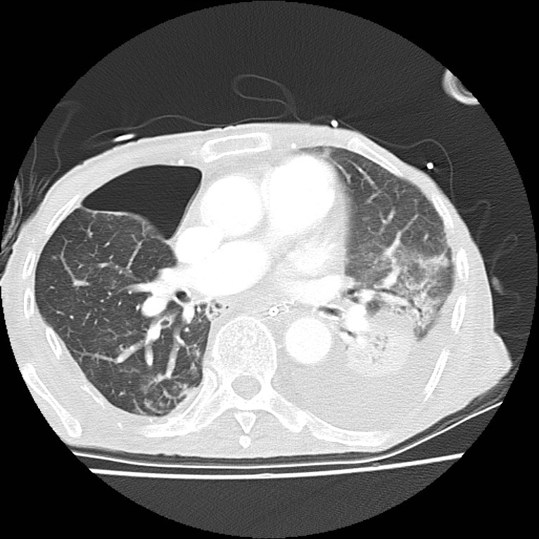 Clagett thoracotomy with bronchopleural fistula (Radiopaedia 29192-29587 Axial lung window 25).jpg