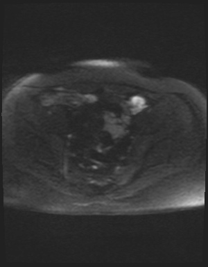 Class II Mullerian duct anomaly- unicornuate uterus with rudimentary horn and non-communicating cavity (Radiopaedia 39441-41755 Axial DWI 42).jpg