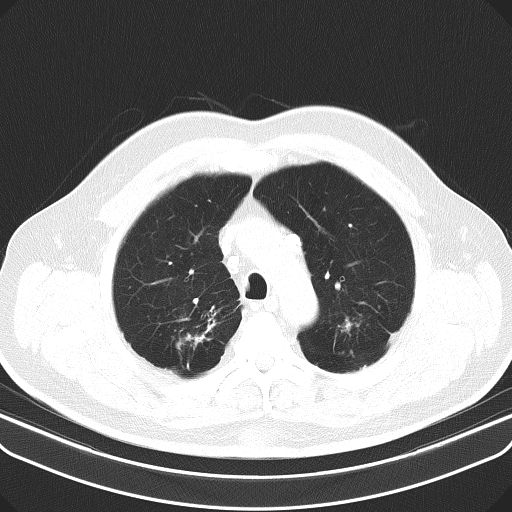 Classic complicated silicosis (Radiopaedia 49720-54961 Axial lung window 14).jpg