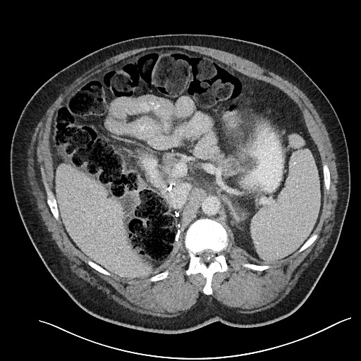 File:Closed loop obstruction - internal hernia into nephrectomy bed (Radiopaedia 59867-67320 A 45).jpg