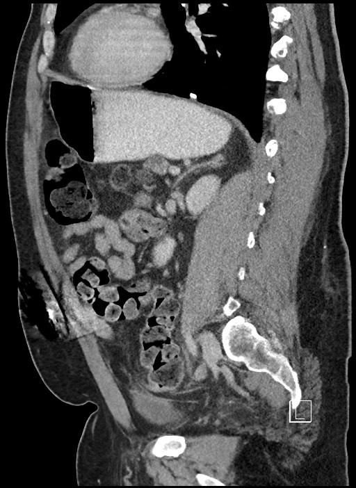 Closed loop obstruction - internal hernia into nephrectomy bed (Radiopaedia 59867-67320 C 32).jpg